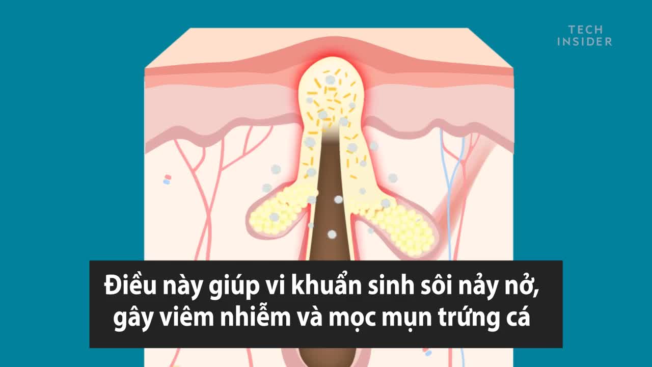 Loài vi khuẩn khiến con người mọc nhiều mụn trứng cá hơn