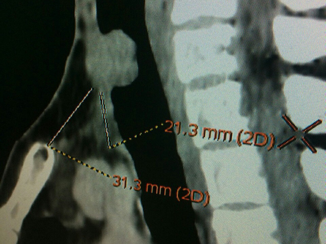 Cứu thành công ca ung thư tuyến giáp di căn vào lòng khí quản
