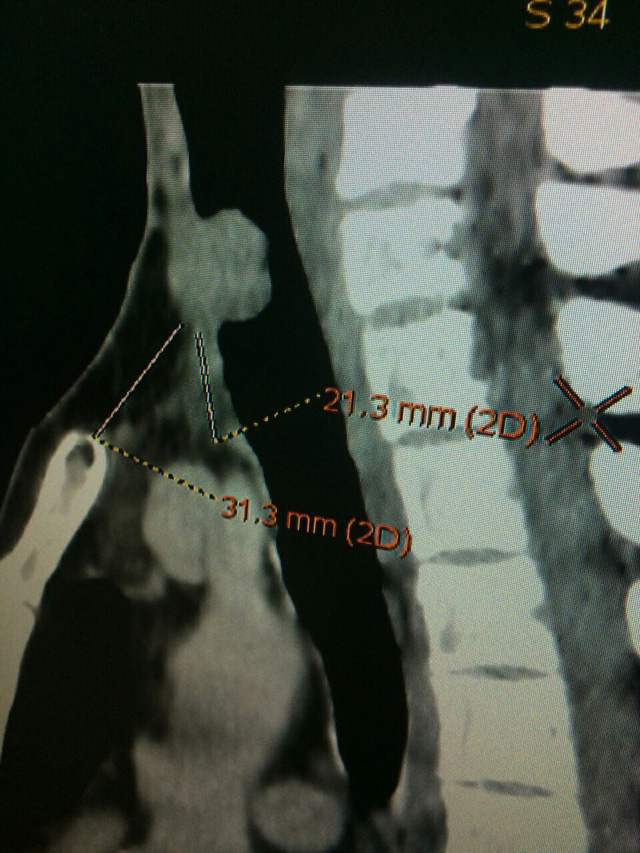 Cứu thành công ca ung thư tuyến giáp di căn vào lòng khí quản cuu thanh cong ca ung thu tuyen giap di can vao long khi quan