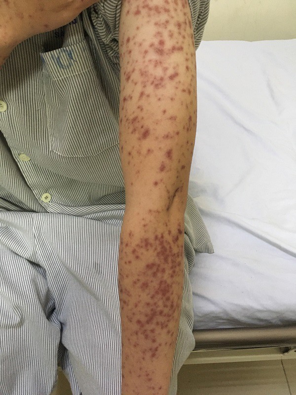 mat phu ne nguoi but rut vi tu mua thuoc tri sot dau dau