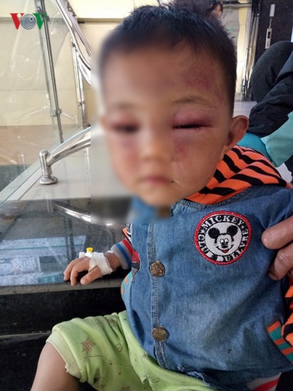 Làm rõ vụ việc bé trai 2 tuổi nghi bị cha dượng bạo hành đến nhập viện