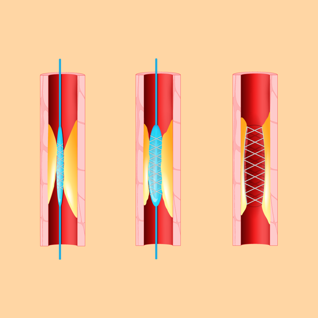 Stent tim: Đặt hay không đặt?