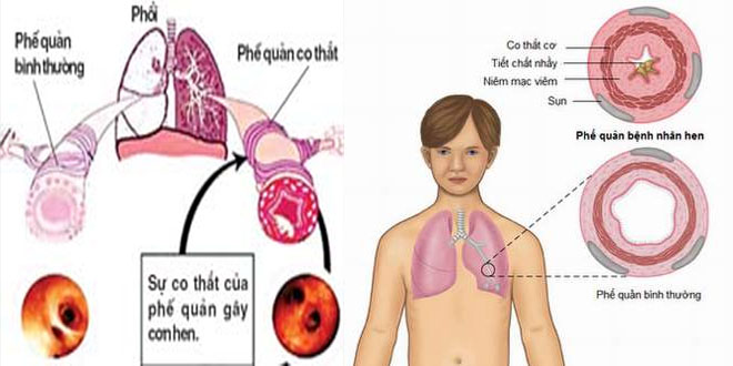 Ðề phòng tác dụng phụ của thuốc giãn phế quản